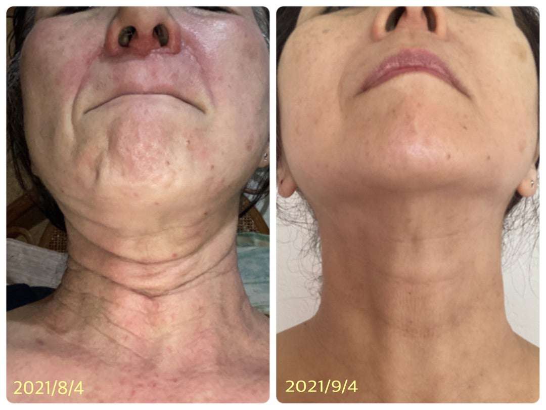 アトピー | 毎月大阪おじひろお話し会開催！親父は医療を使わず高血圧・糖尿病・膀胱癌を克服✨