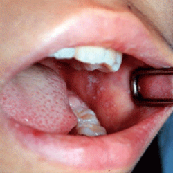 麻疹患者、大阪市で開催のAKB48握手会に参加：日経メディカル