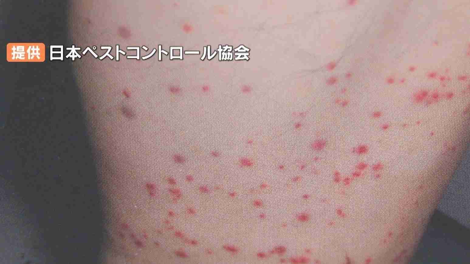 トコジラミ国内で被害相次ぐ　知らぬ間に荷物や衣類に…強い繁殖力でかまれると痒みや発疹　インバウンド増加で上陸か | TBS NEWS DIG