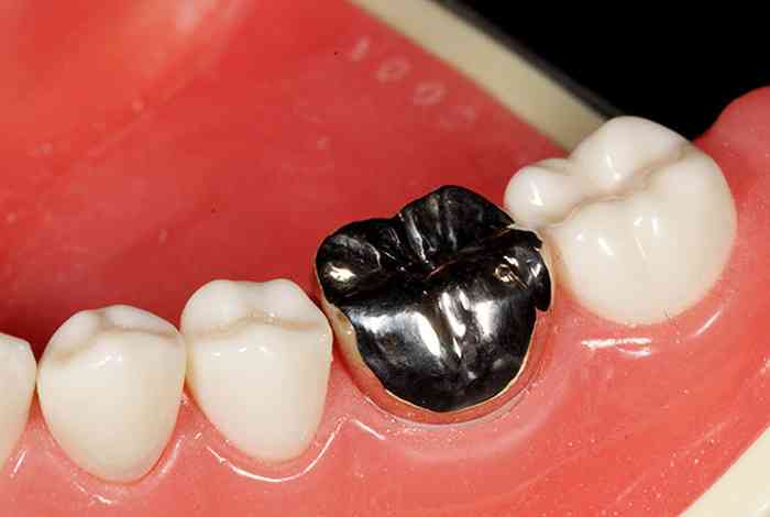 銀歯は印象がマイナス?