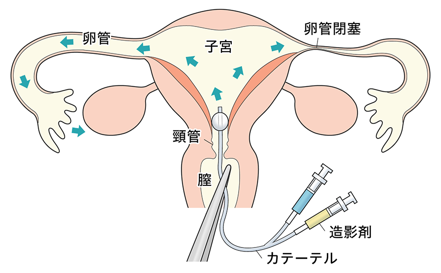 卵管造影検査が怖い