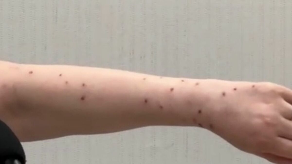 新型コロナワクチン接種後に「倦怠感」「皮膚炎」に苦しむ50代女性　国やファイザー社に損害賠償を求め提訴　ワクチンの有害性も立証へ | 東海地方のニュース【CBC news】 | CBC web