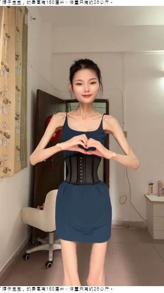 【海外発！Breaking News】身長160センチ、体重25キロの女性「踊る骸骨」と揶揄されるも「もっと痩せたい」（中国） | Techinsight（テックインサイト）|海外セレブ、国内エンタメのオンリーワンをお届けするニュースサイト