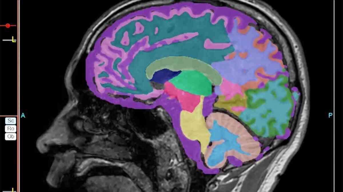 帯状疱疹ワクチンで認知症リスク低下の可能性　米研究（CNN.co.jp） - Yahoo!ニュース