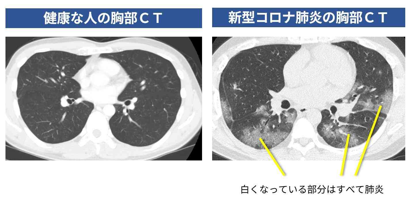 新型コロナ　時間差でやってくる「免疫性肺炎」に注意