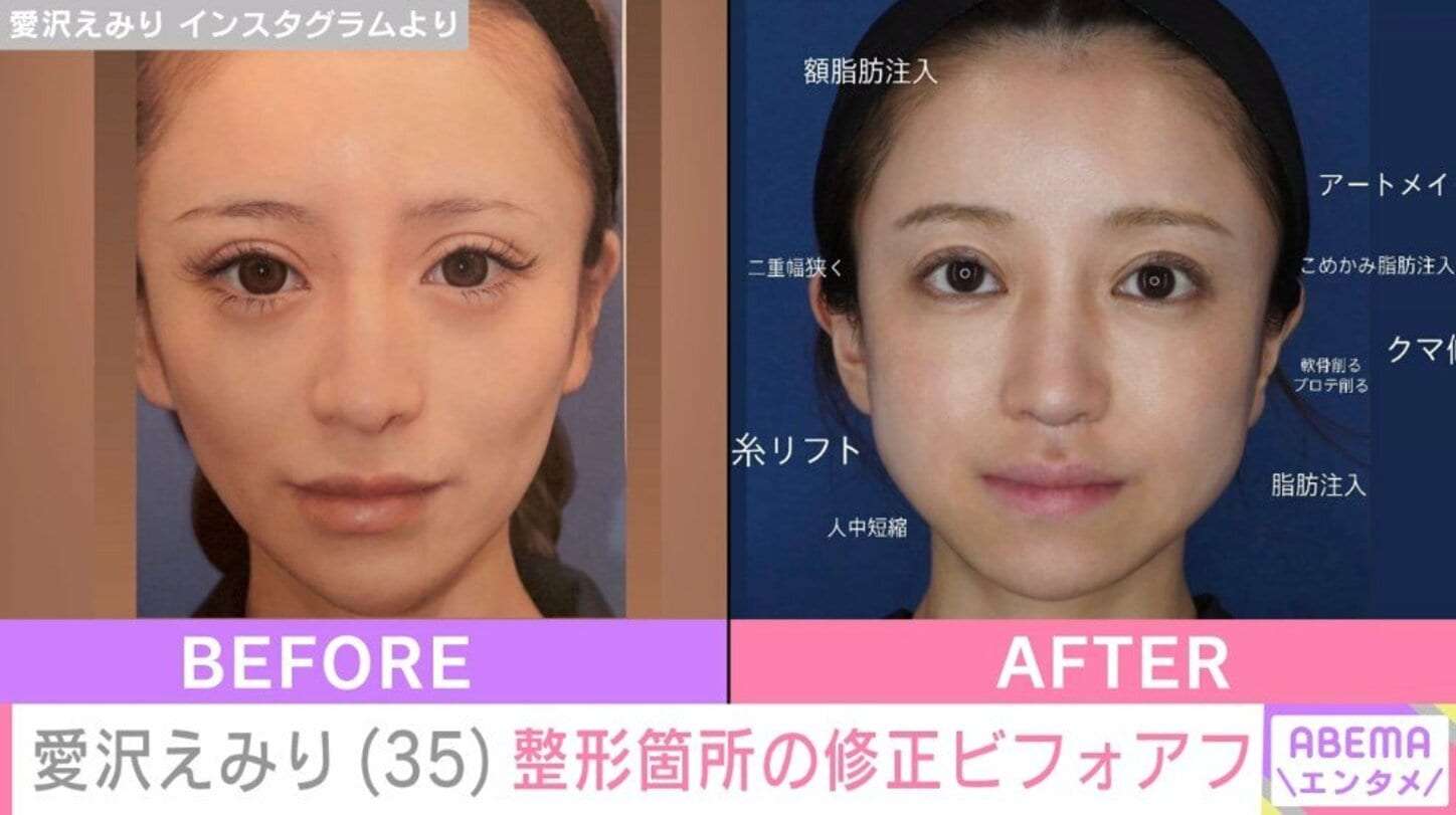元歌舞伎町No.1キャバ嬢・愛沢えみり（35）、整形箇所の修正を報告＆ビフォアフ公開 「土台は思い切って課金する」