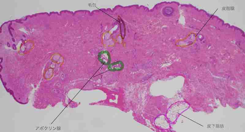 ミラドライ の治療効果　１パスでも十分？　その２ | ミラドライブログ