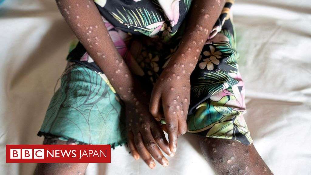 WHO、エムポックスで「公衆衛生上の緊急事態」を宣言 - BBCニュース