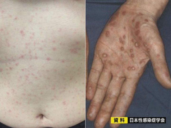 古くは“家康の次男”もかかり死亡…去年全国約1万3千人が感染『梅毒』の歴史 江戸時代は遊郭などで急増 | 東海テレビNEWS