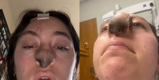 犬に鼻を噛まれた女性、頭皮を皮膚移植したら鼻先から毛が生えてきてしまう - コノユビニュース