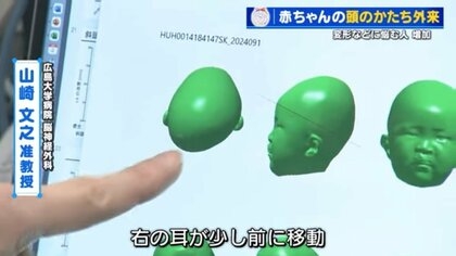「赤ちゃんの頭の形が気になる」 ヘルメットで矯正の外来に受診者急増　生後6か月までに始めると効果的　広島大学病院