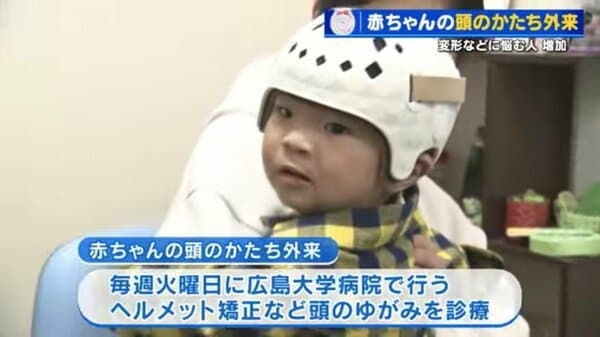 「赤ちゃんの頭の形が気になる」 ヘルメットで矯正の外来に受診者急増　生後6か月までに始めると効果的　広島大学病院｜FNNプライムオンライン