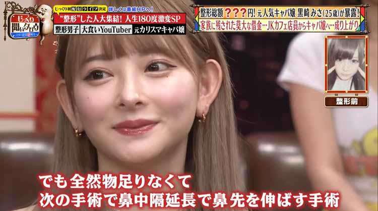 整形総額1300万円超、32歳YouTuberが今昔比較　アンチコメに負けず「私の好きな私になれました！」