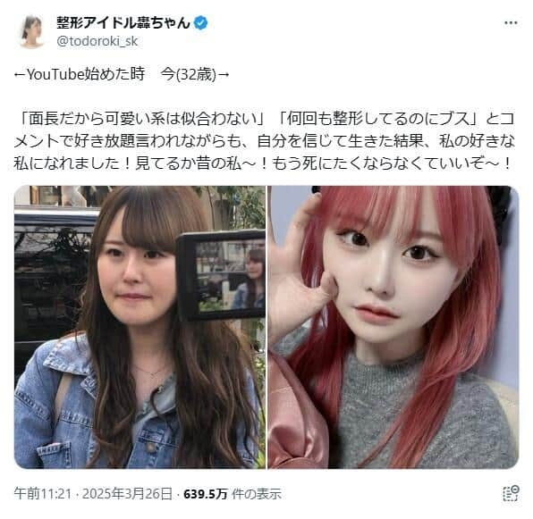 整形総額1300万円超、32歳YouTuberが今昔比較　アンチコメに負けず「私の好きな私になれました！」: J-CAST ニュース