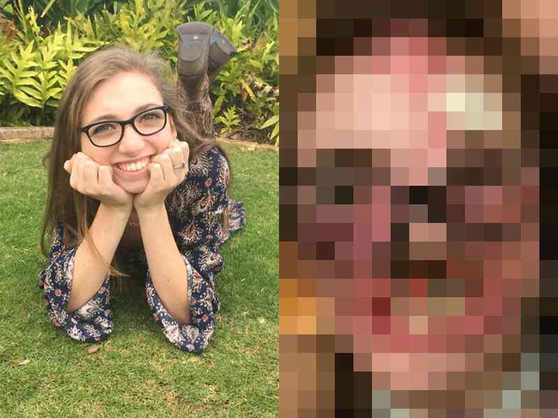 犬に800回噛まれ顔面を失った女子大生「顔から皮膚が垂れ下がるのを感じた」 希望失わず、将来は犬の訓練士に（2023年3月12日）｜BIGLOBEニュース