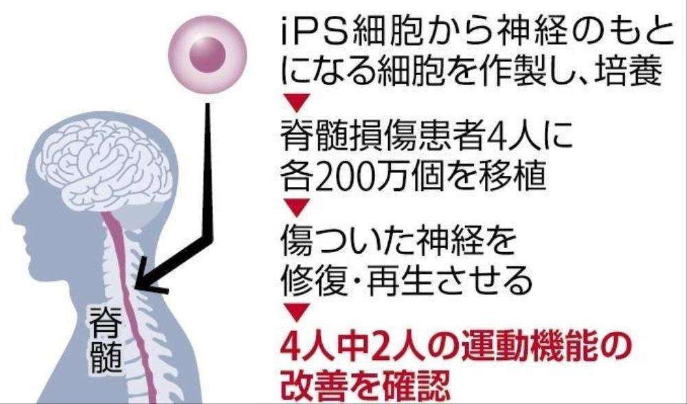 iPS細胞移植後に2人の運動機能が改善、脊髄損傷患者が自分で食事をとれるように…世界初