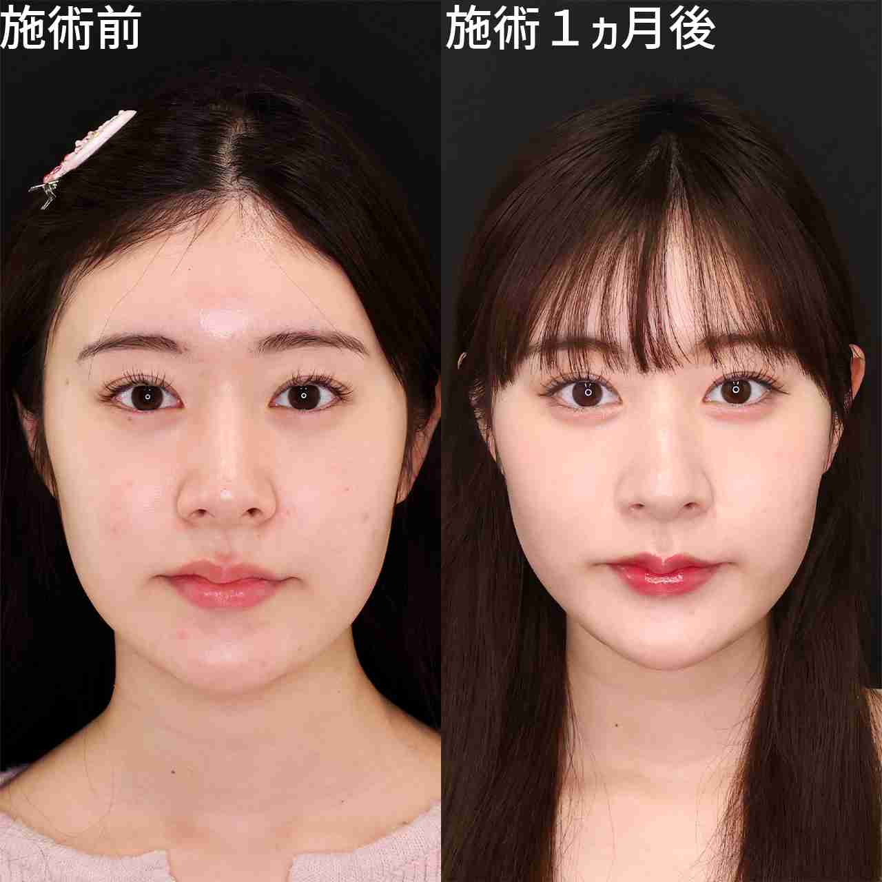 元NGT48メンバーが整形箇所と総額を赤裸々告白「高かったんですけど、早めに可愛くなってうれしい」