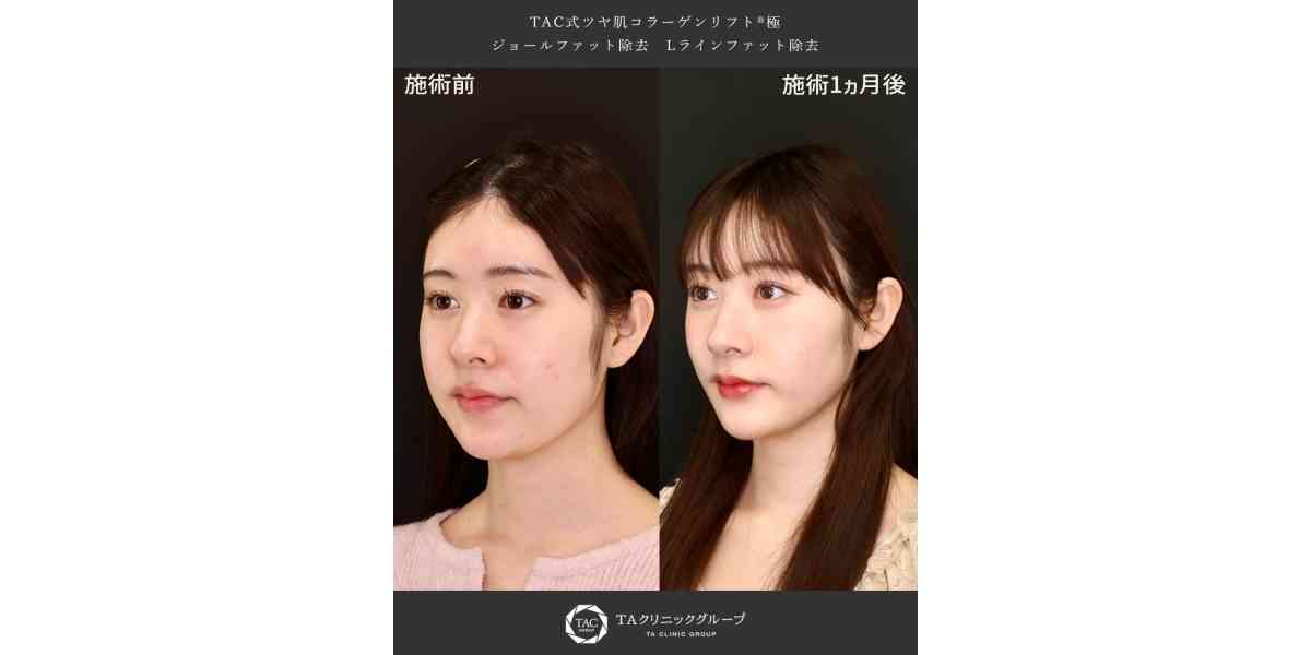 加藤 美南さんがDr.もりもりの小顔整形でさらに可愛くご本人大満足でネットニュースに！｜症例写真・ビフォーアフター｜美容整形･美容外科のTAクリニックグループ