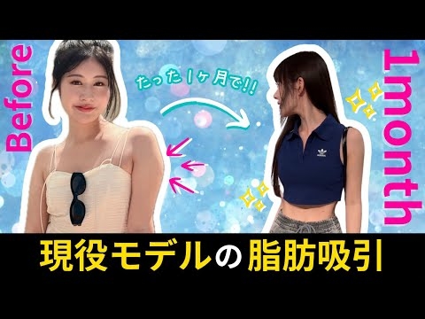 【二の腕痩せ】現役モデルの美容整形に密着！ダウンタイムを短くする方法とは？