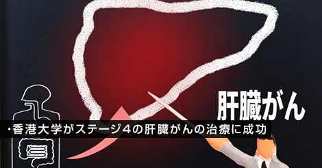 香港大学がステージ4の肝臓がんの治療に成功 | 香港BSニュース
