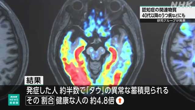 “認知症発症関わるたんぱく質”うつ病患者の脳に高割合で蓄積