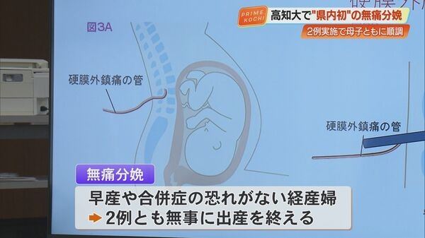 【高知】全国最後、県内初の無痛分娩　高知大で実施、2例とも「無事に出産を終えた」｜FNNプライムオンライン