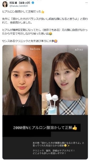 兒玉遥「ヒアルロン酸溶かして正解」ビフォーアフター公開に反響「綺麗」「勇気ある決断」