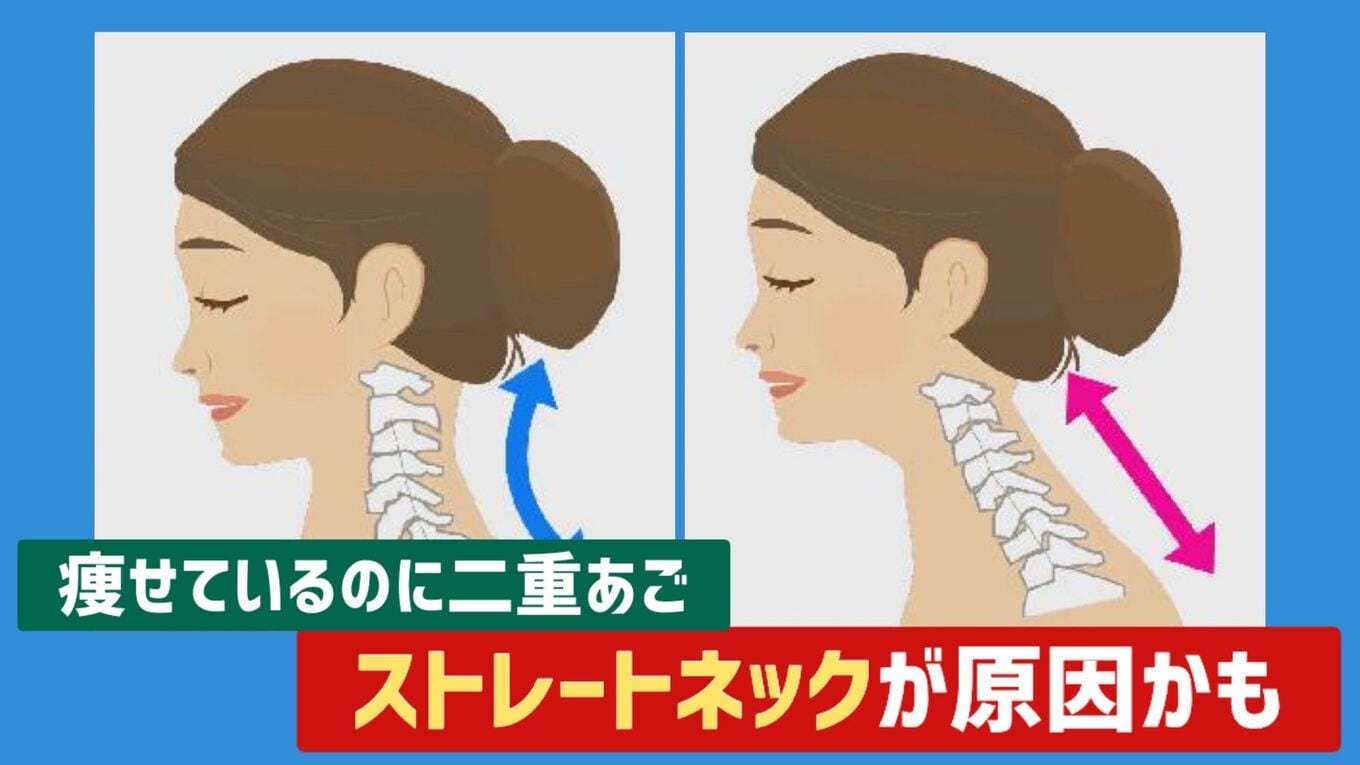 痩せているのに “ 二重あご ”…ストレートネックが原因かも 放置すると「椎間板ヘルニア」のリスクも 若者に多い現代病の対策は