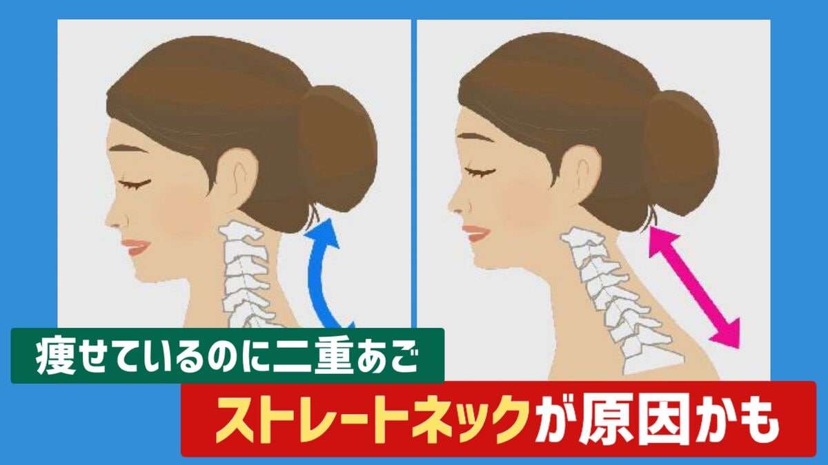 痩せているのに “ 二重あご ”…ストレートネックが原因かも 放置すると「椎間板ヘルニア」のリスクも 若者に多い現代病の対策は | TBS NEWS DIG (1ページ)