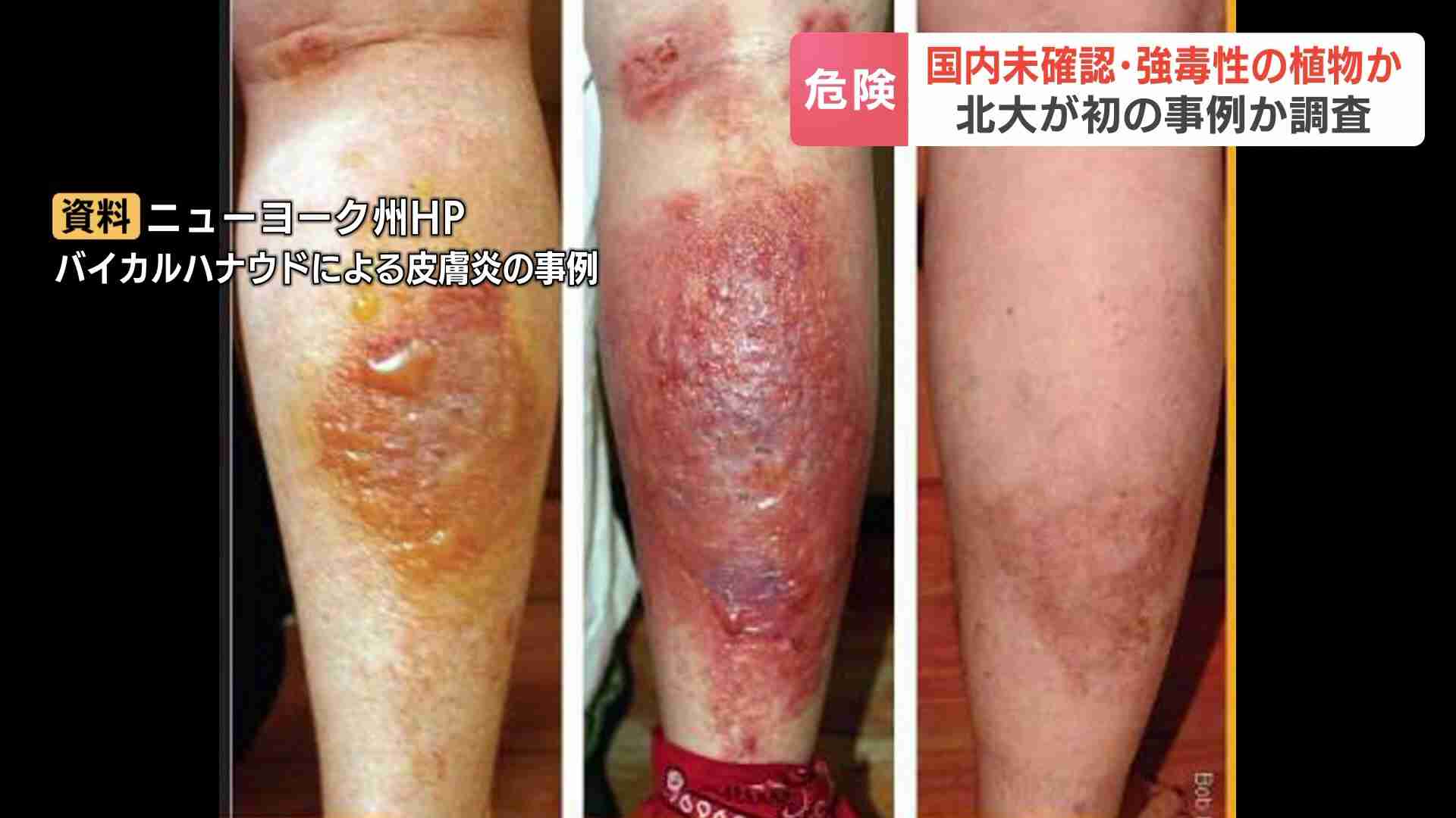 国内未確認の強毒性植物か 北大構内で見つかる…樹液が皮膚につくと重い皮膚炎 撮影した女性は「アジサイのような白い花」環境省などが調査(HBCニュース北海道) - Yahoo!ニュース