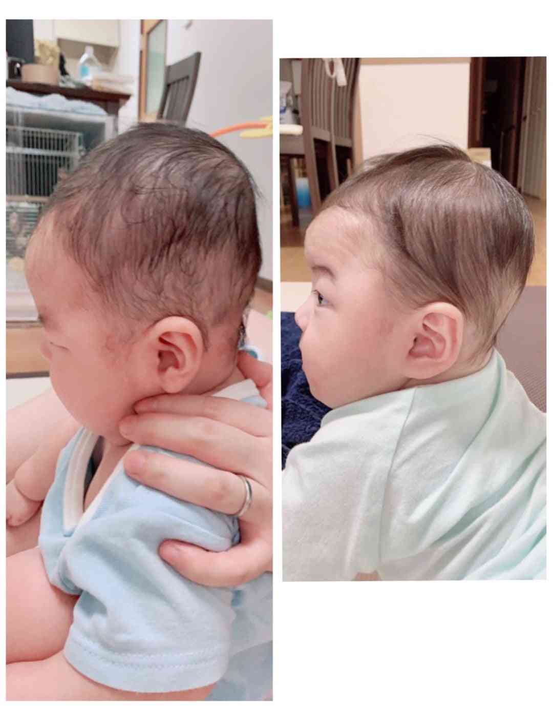 赤ちゃんのヘルメット治療が物議…“親心”が子のルッキズムを助長?高須幹弥院長「責任を感じて『治してあげたい』気持ちはわからなくもない」