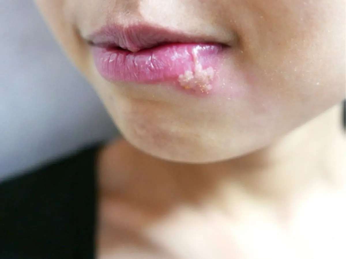 ヘルペスウイルス感染が「アルツハイマー病」の発症に関与? リスク増加の可能性を研究で示唆（メディカルドック） - Yahoo!ニュース