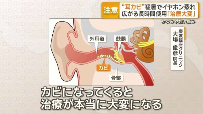 イヤホンの長時間使用広がり「耳カビ」注意　猛暑で耳の中が蒸れ繁殖「治療が大変」
