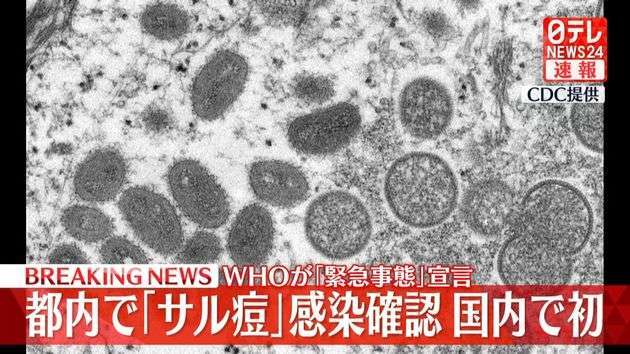東京都内で国内初「サル痘」感染者を確認