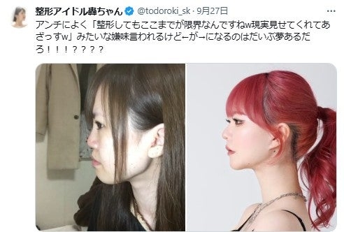 整形アイドル轟ちゃん、整形前後の横顔公開に反響「鼻の変化にびっくり」「努力がすごい」