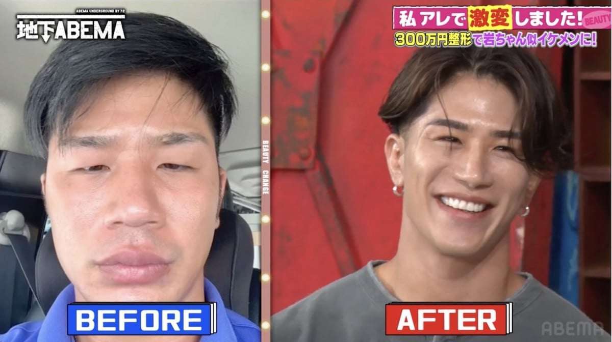 《メンタルを保つため美容整形に走った》アイドル時代に総額1000万円以上を費やした元HKT48・兒玉遥の「後悔」