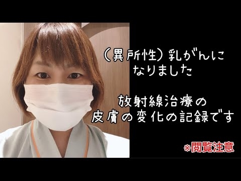 異所性乳がんになりました『放射線治療の皮膚の変化の記録』です！頑張った自分に?