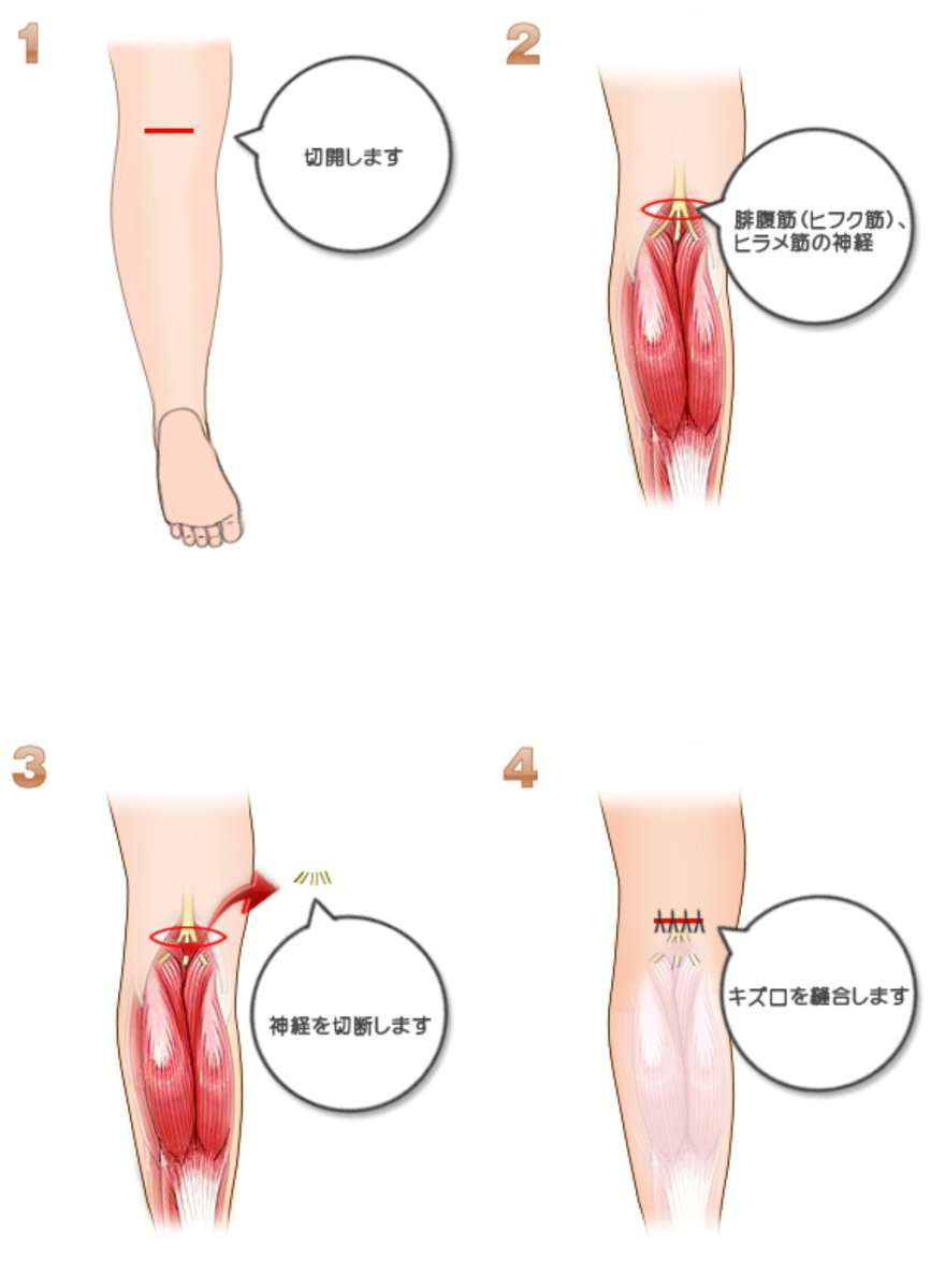 美脚整形とダイエット薬の罠、ふくらはぎ神経遮断とマンジャロに潜む“命の危険”