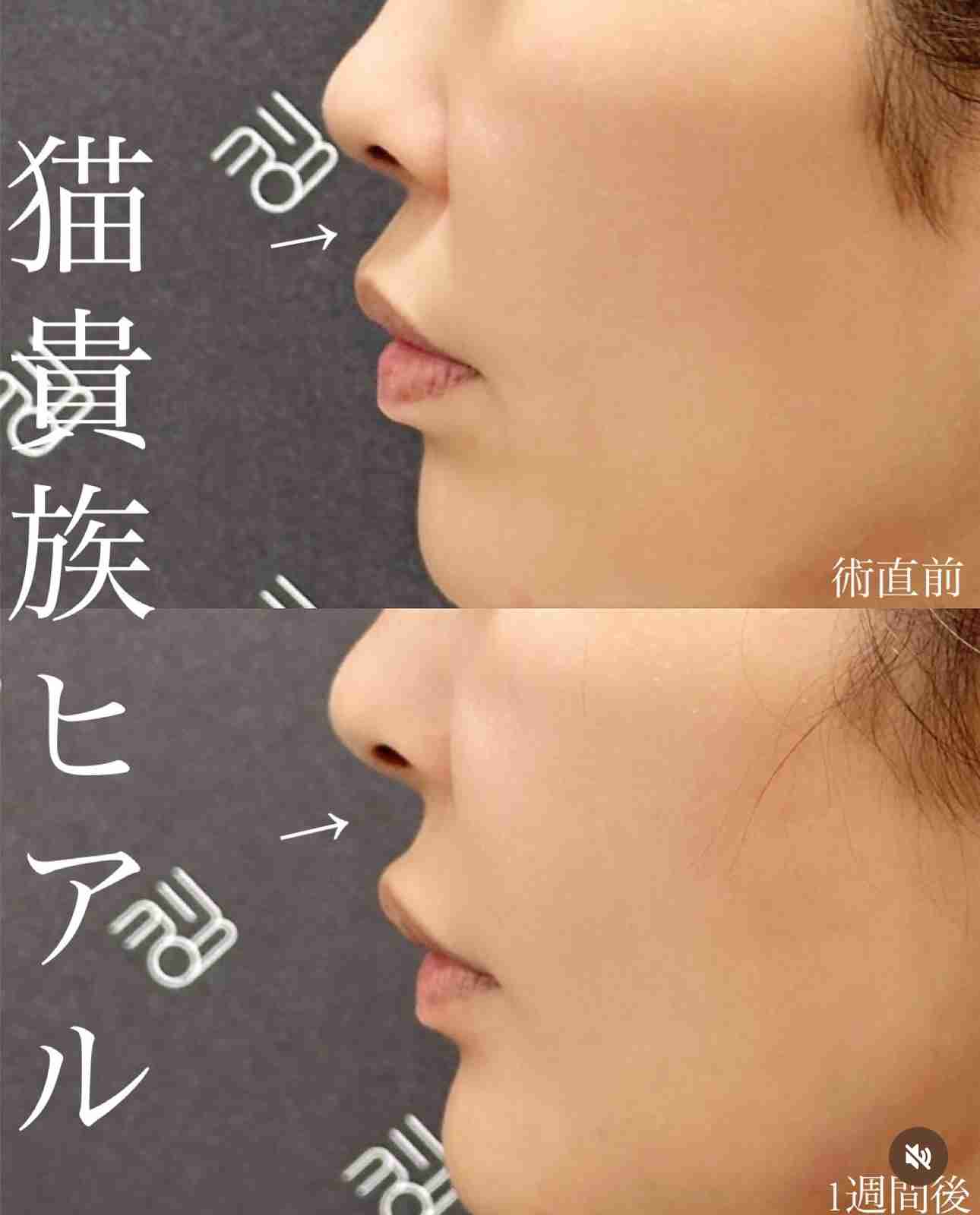 年齢が行ってから美容整形した方！