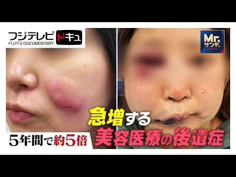 【Mr.サンデー】脂肪吸引直後に意識不明で救急搬送！急増する美容医療“後遺症”の実態【実録ドキュメント】