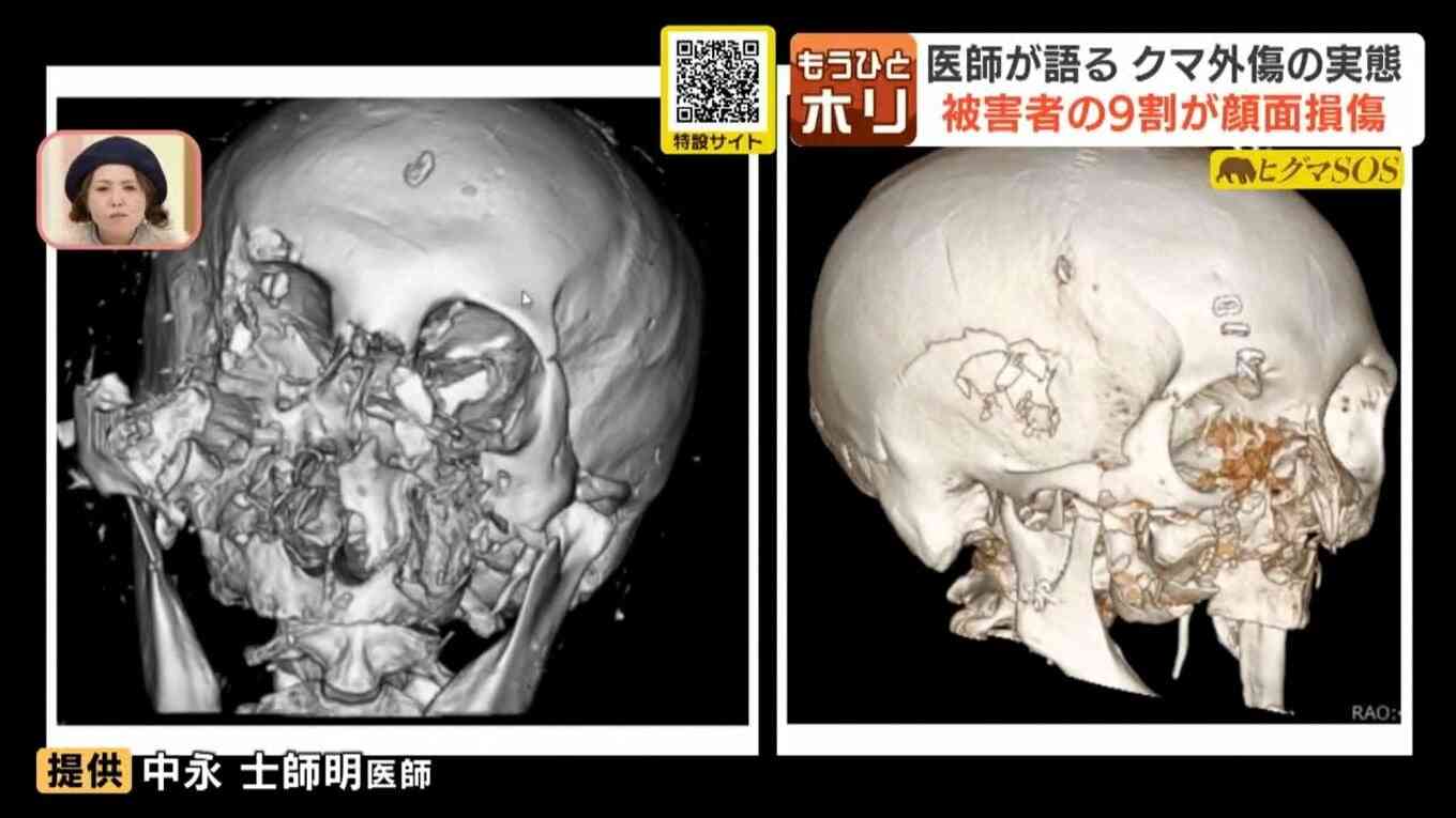 全国初の「緊急銃猟」　仙台・太白区の住宅街に出没したクマを駆除、市街地での緊急の猟銃使用を許可