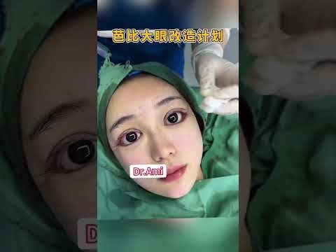 芭比大眼改造计划，灵动的眼睛? #fyp #facelift #plasticsurgery #bigeyes #doubleeyelids #eyesynthesis #BarbieEyes