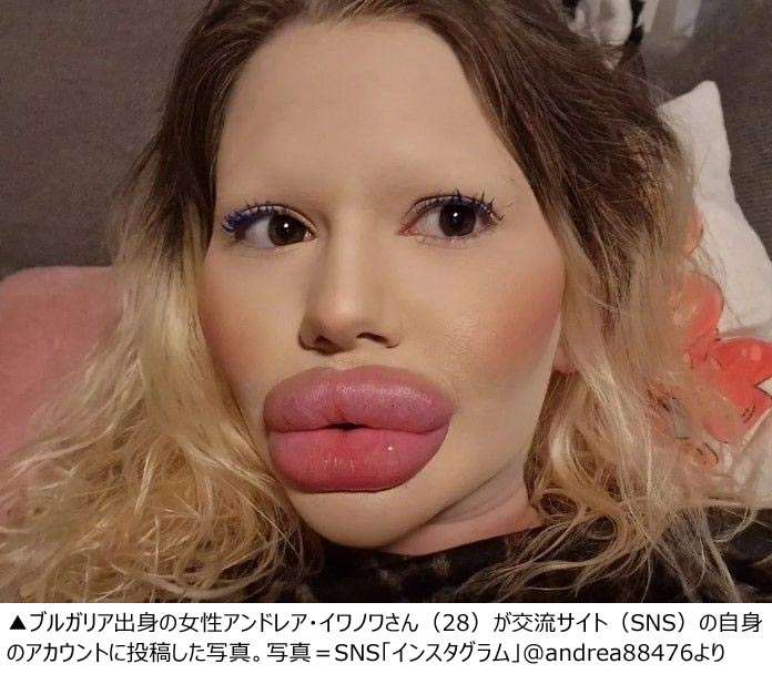 【閲覧注意】ヒアルロン酸注射に400万円使ったブルガリア女性（28）、周囲の心配よそに「たらこ唇」継続に意欲