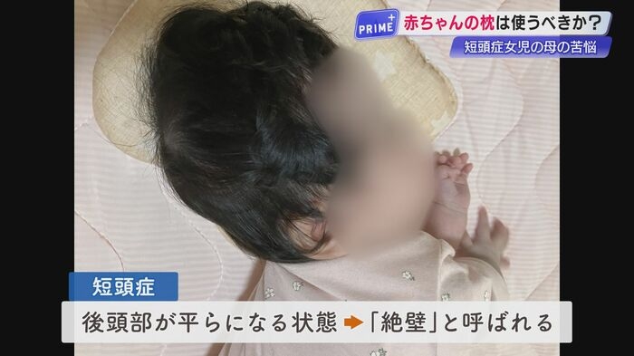 「枕なし」を信じたのに…赤ちゃんの頭がぺっちゃんこ、枕は必要か?国や医師の見解が真っ二つ