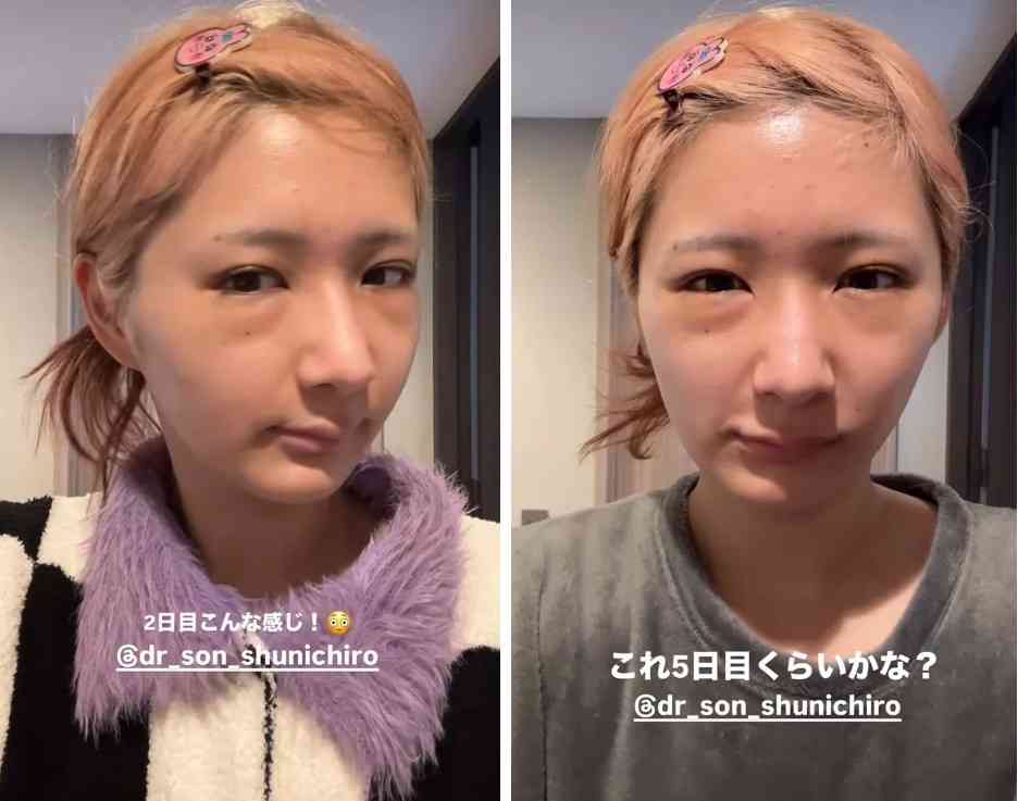 しなこ、整形告白 無加工ビフォーアフター公開「見比べると印象が全然違う」