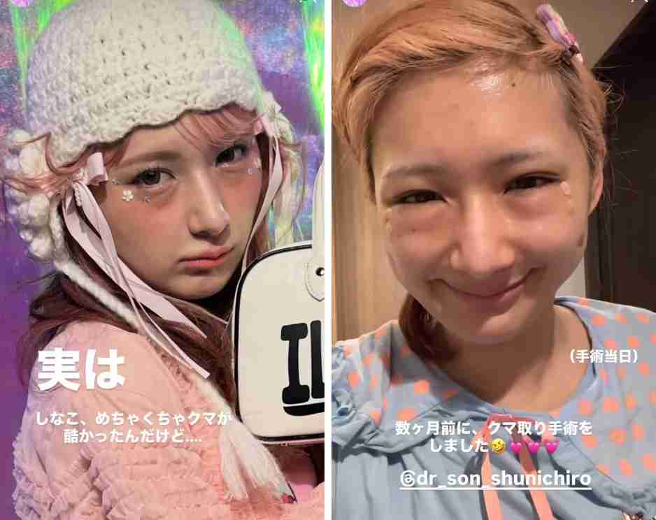 しなこ、整形告白 無加工ビフォーアフター公開「見比べると印象が全然違う」