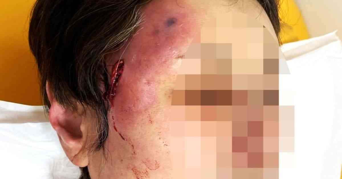 「美容整形の後遺症」鼻が変形、慢性痛にしびれ、壊死に死亡例も…5年で5倍！現場から医師の警告