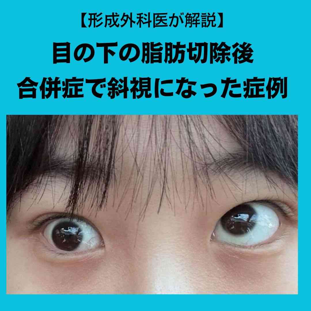 目の下の脱脂術後の合併症で斜視になった症例、改善方法とは？ | 銀座みやこクリニック美容皮膚科（順天堂大教授による安心施術）