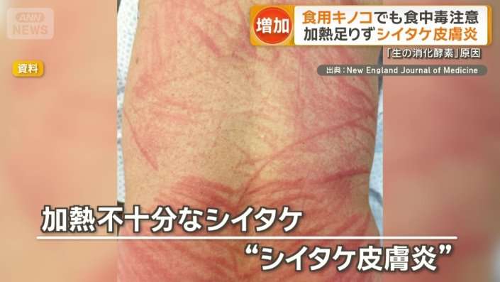 食用キノコでも食中毒に注意　加熱足りず「シイタケ皮膚炎」発症　安全に食べるには？