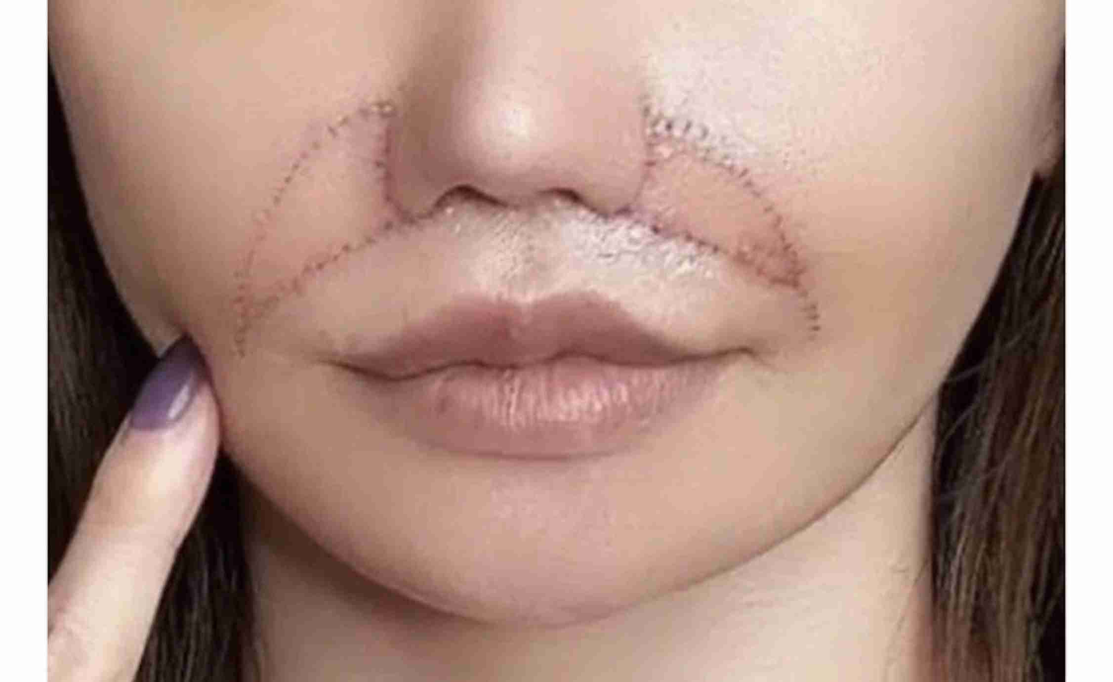         「目の下のくま取り治療が原因で失明しかけた人も」片目縮小、顔がボコボコ…美容整形によるトラブルが急増しているワケ  |  日刊SPA!    